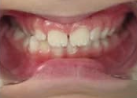 crossbite B