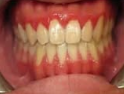 underbite a