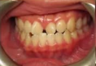 underbite b